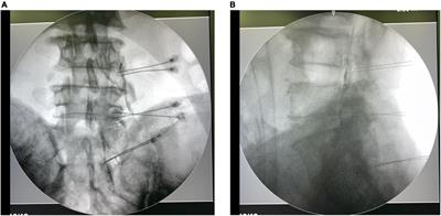 Dorsal root ganglion pulsed radiofrequency using bipolar technology in patients with lumbosacral radicular pain duration ≥ 2 years